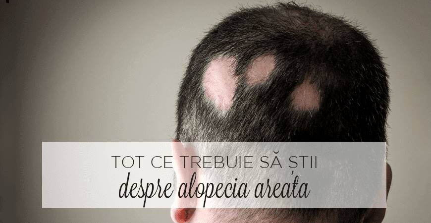 Ce trebuie să știi despre alopecia areata?