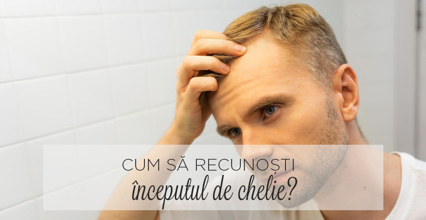 Cum să recunoști începutul de chelie Cum să recunoști începutul de chelie