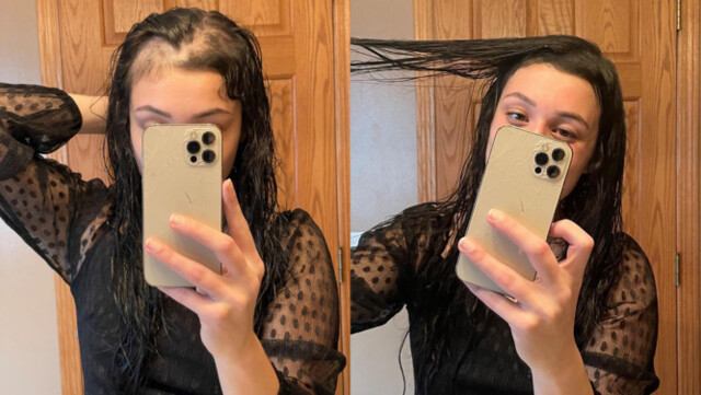 Rezultate Toppik alopecie Rezultate Toppik alopecie