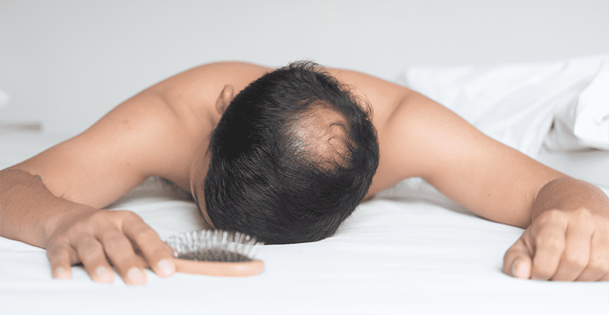 barbat care sufera de chelie barbat care sufera de chelie