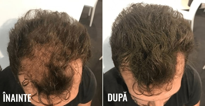păr înainte și după Toppik păr înainte și după Toppik